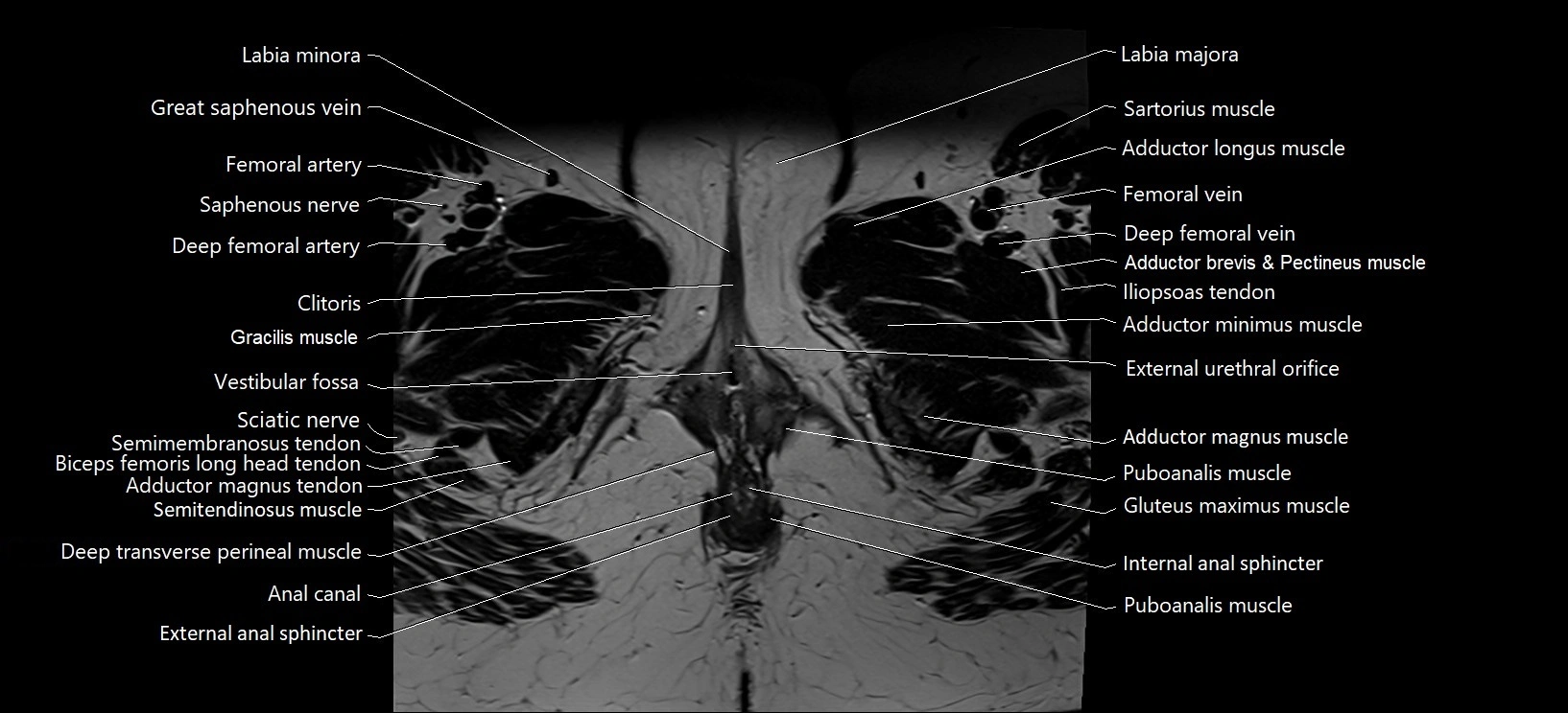 Axial cross sectional anatomy of female pelvis (MRI 3T) image 45.webp